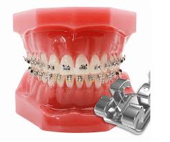Orthodontics (Premium SS Brackets)